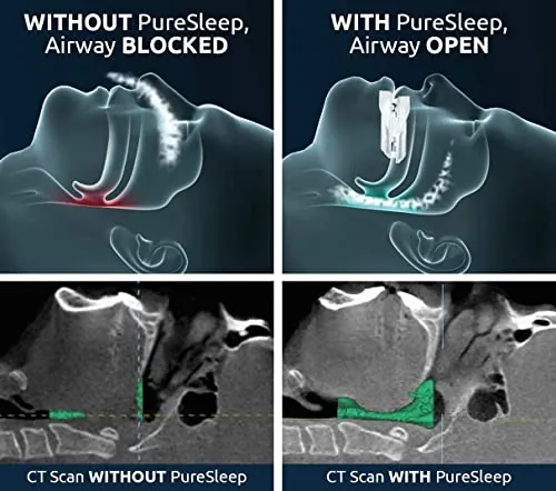 PureSleep Review: Anti-Snoring Mouthpiece for Sleep Support image 3